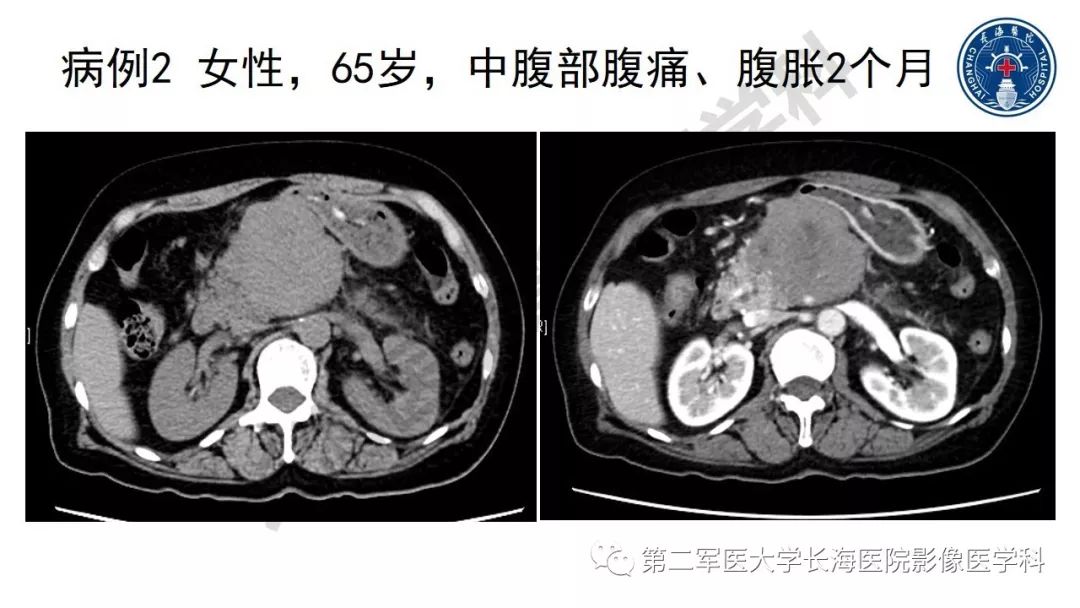 【PPT】胰腺淋巴瘤