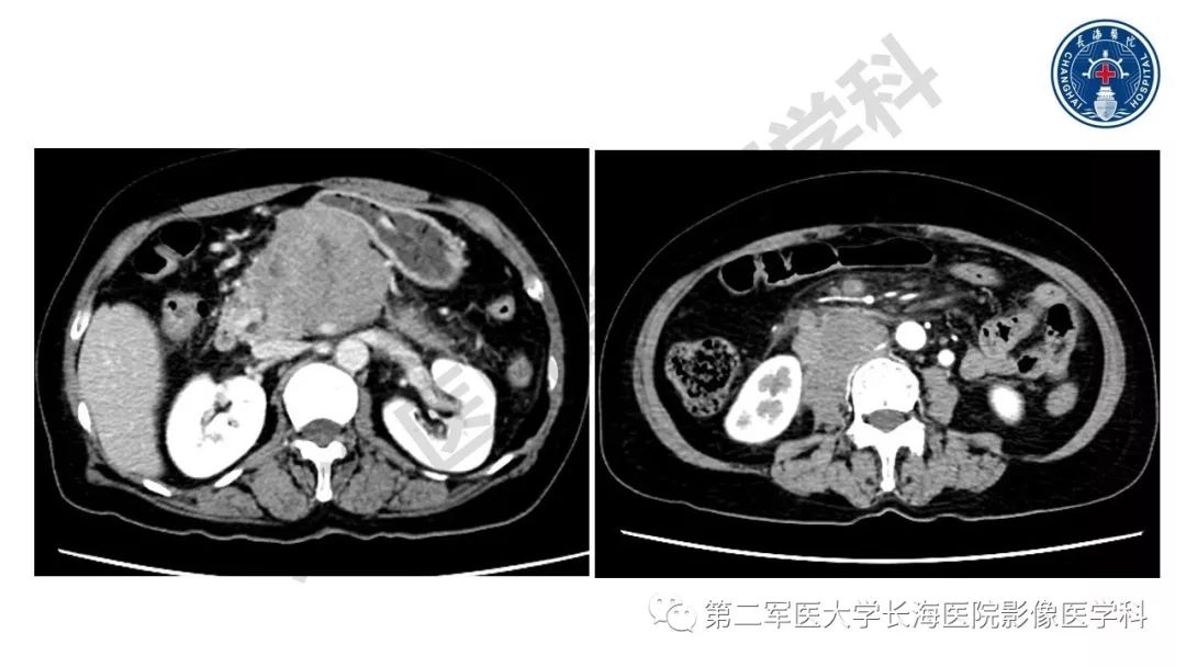 【PPT】胰腺淋巴瘤