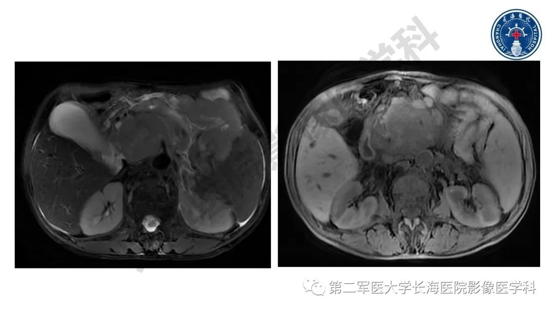 【PPT】胰腺淋巴瘤