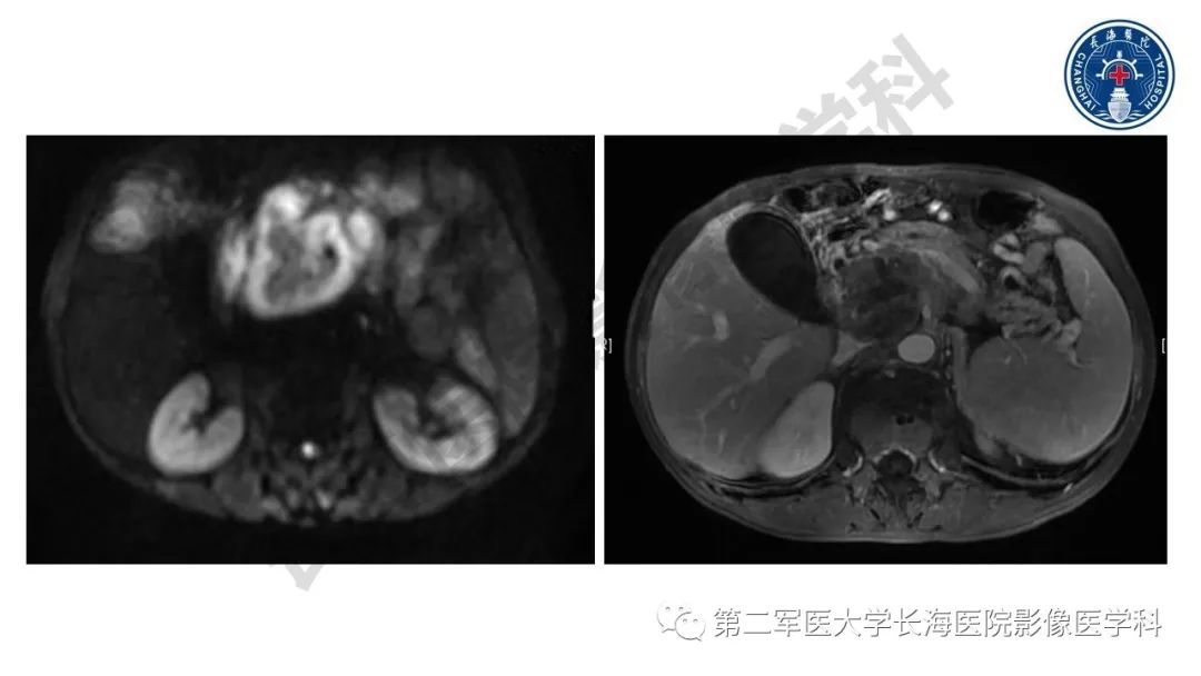 【PPT】胰腺淋巴瘤