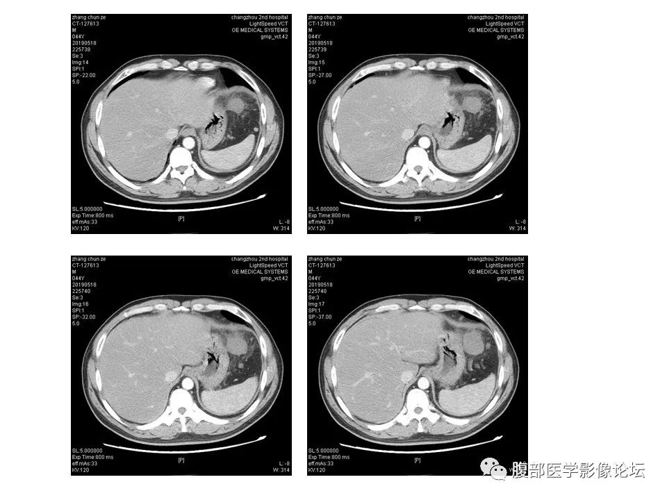 【病例】胃肠道间质瘤1例CT影像