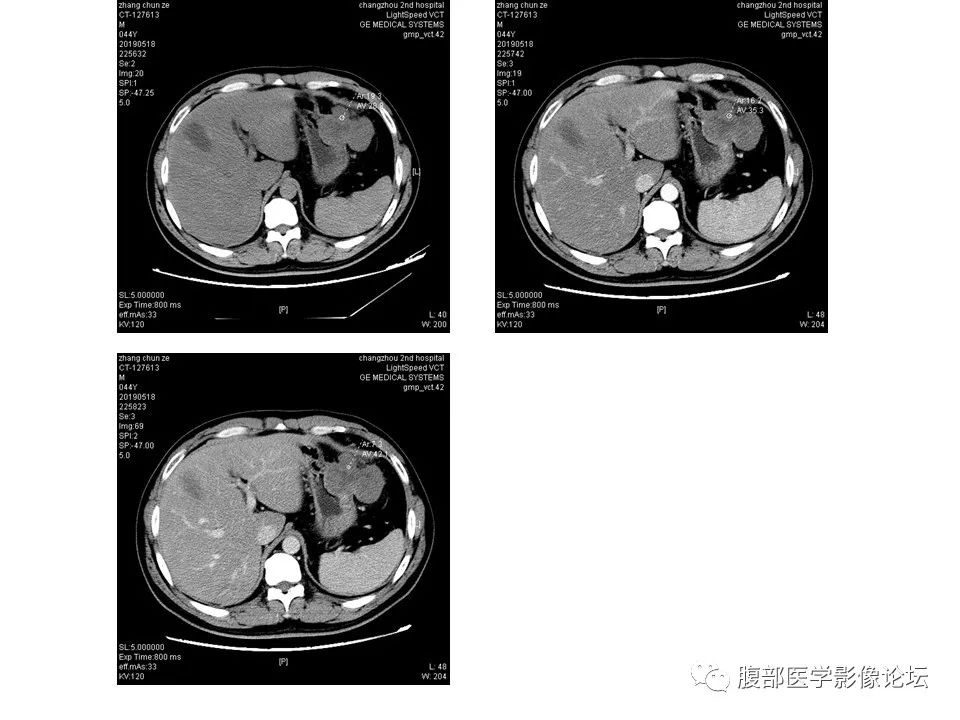 【病例】胃肠道间质瘤1例CT影像