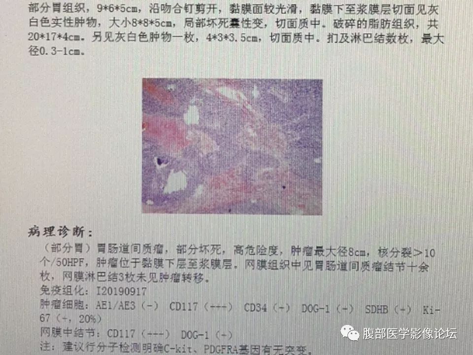 【病例】胃肠道间质瘤1例CT影像