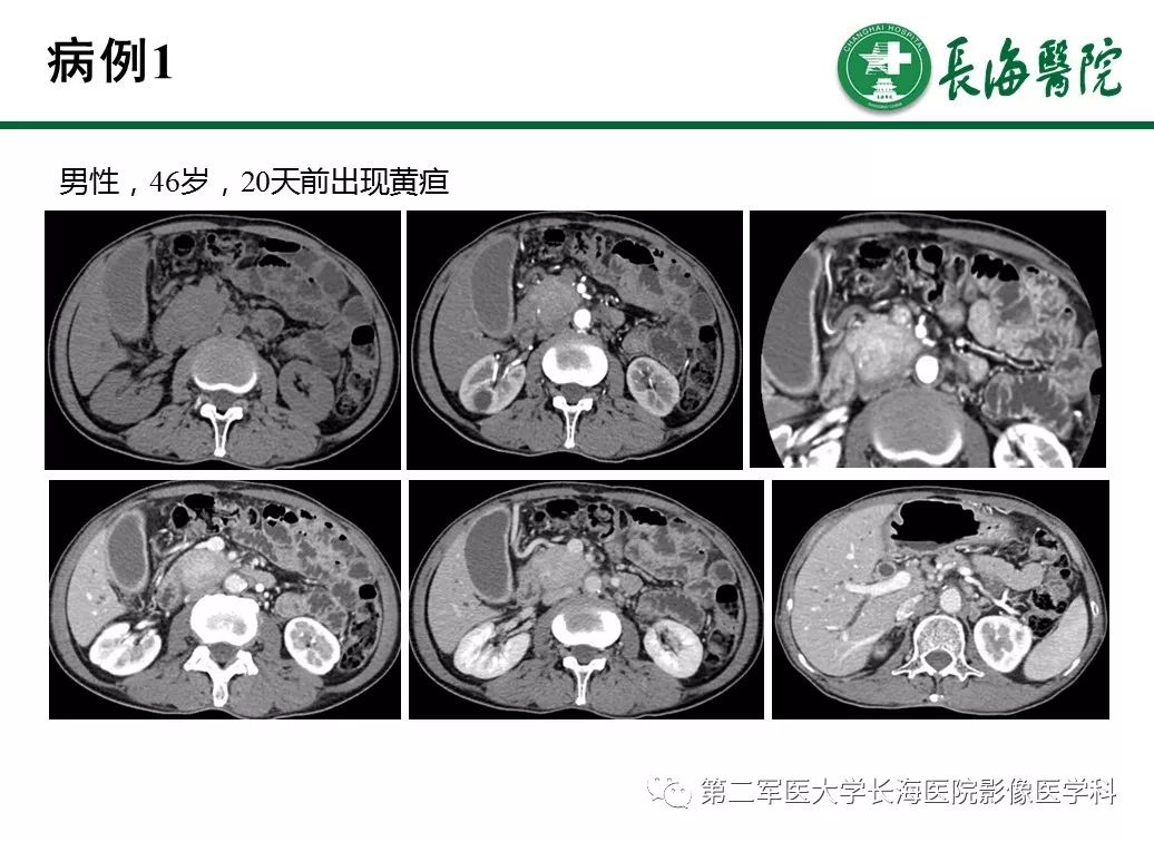 【PPT】IgG4相关性自身免疫性胰腺炎及相关性疾病
