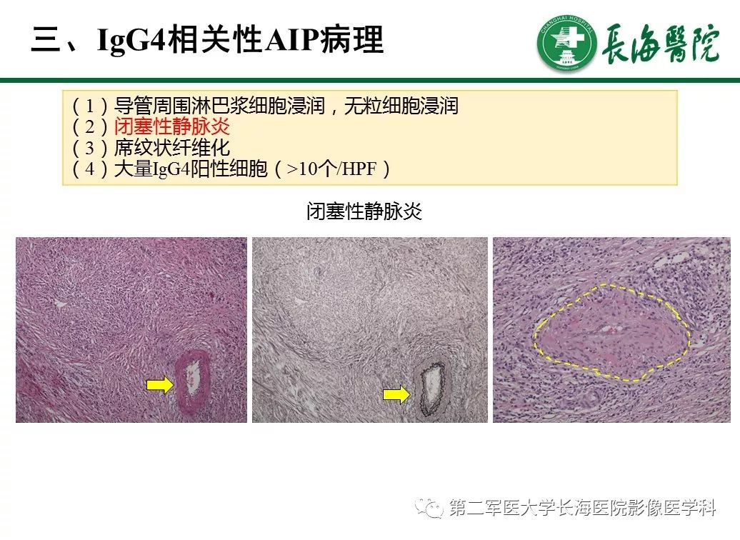 【PPT】IgG4相关性自身免疫性胰腺炎及相关性疾病