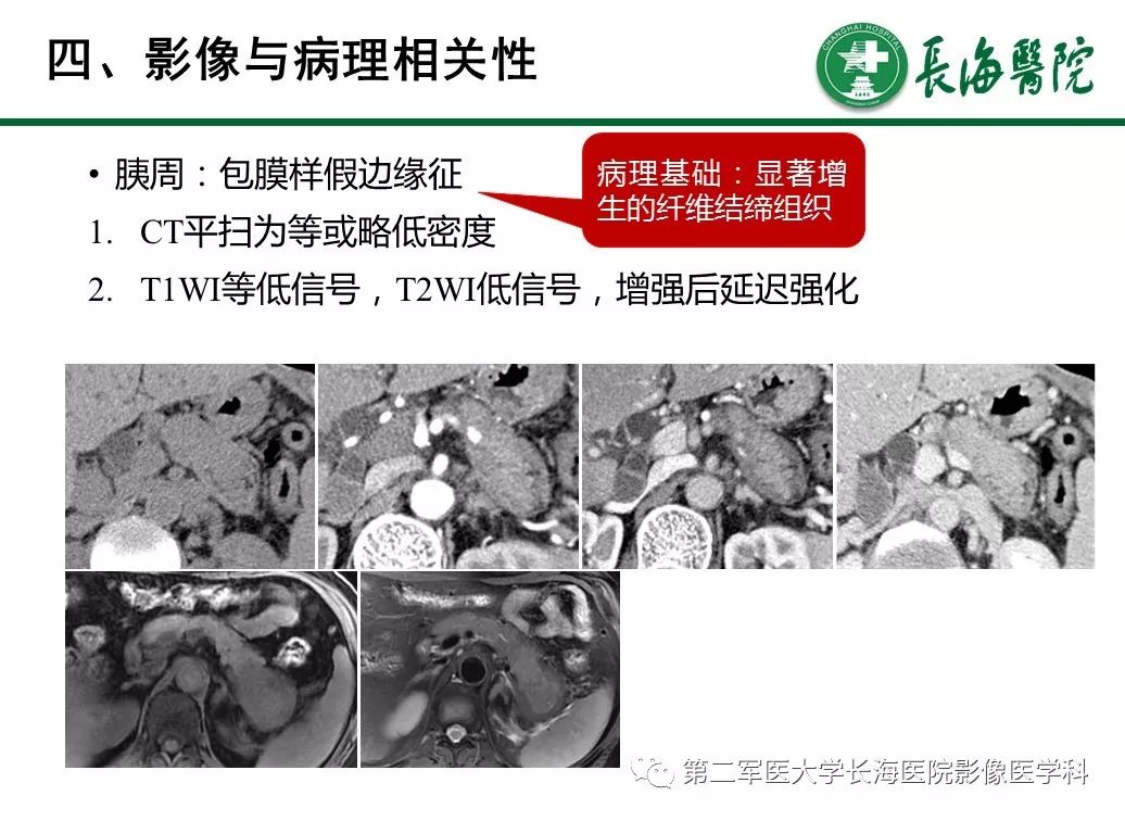 【PPT】IgG4相关性自身免疫性胰腺炎及相关性疾病