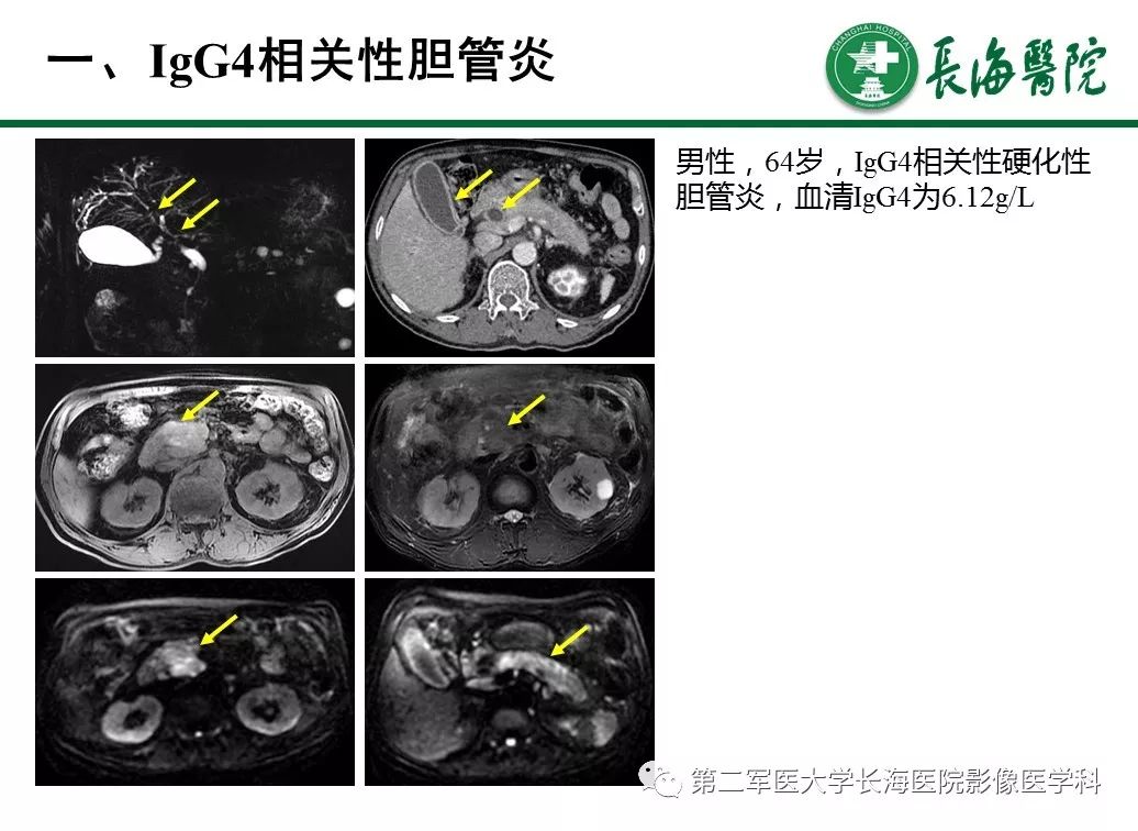 【PPT】IgG4相关性自身免疫性胰腺炎及相关性疾病