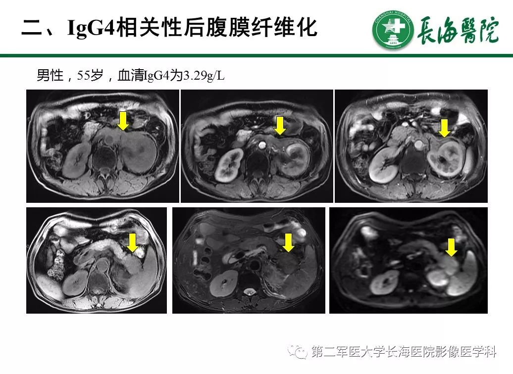 【PPT】IgG4相关性自身免疫性胰腺炎及相关性疾病