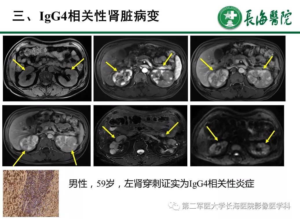 【PPT】IgG4相关性自身免疫性胰腺炎及相关性疾病