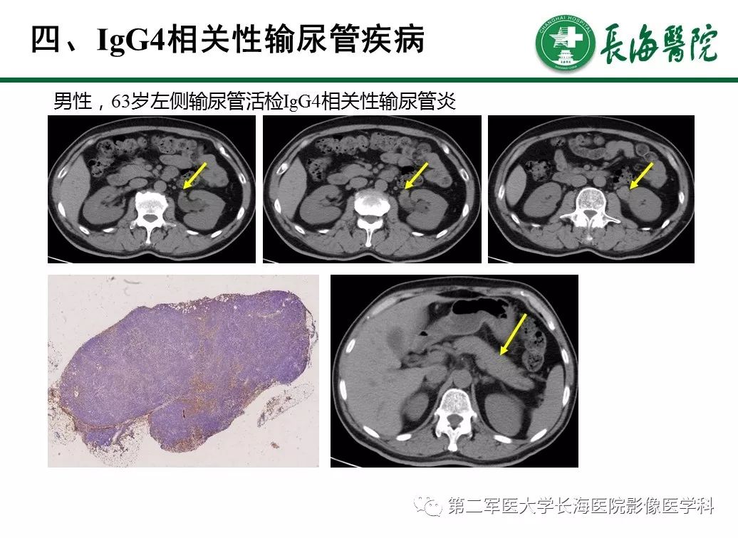 【PPT】IgG4相关性自身免疫性胰腺炎及相关性疾病