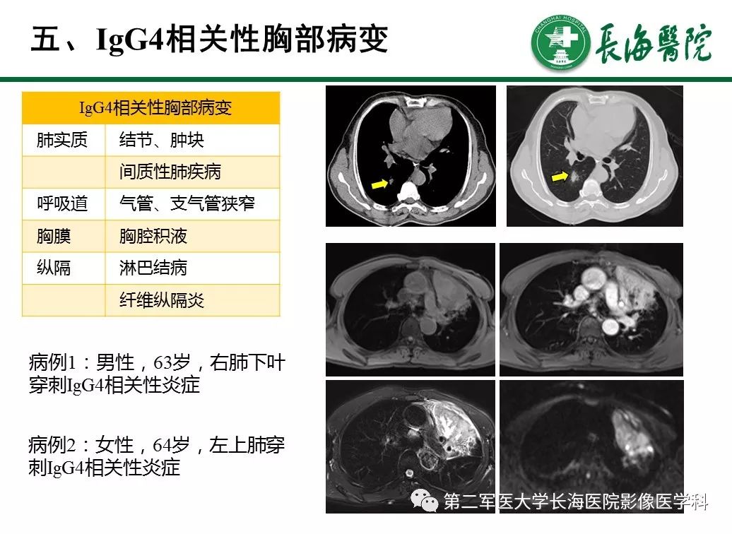 【PPT】IgG4相关性自身免疫性胰腺炎及相关性疾病