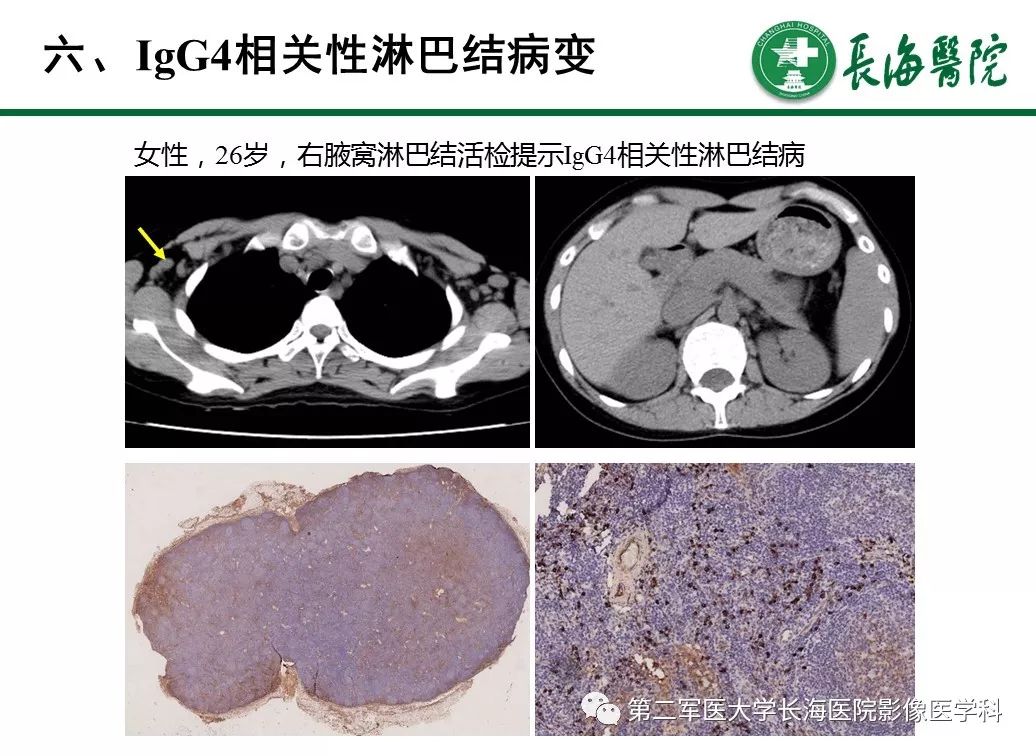 【PPT】IgG4相关性自身免疫性胰腺炎及相关性疾病