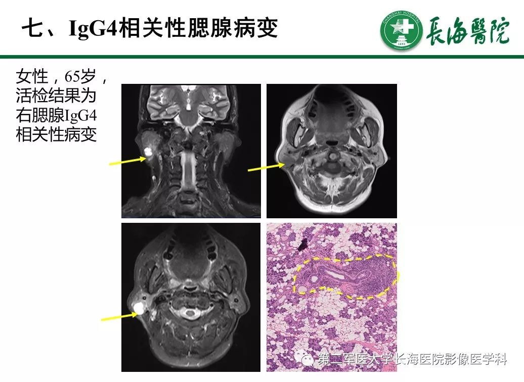 【PPT】IgG4相关性自身免疫性胰腺炎及相关性疾病