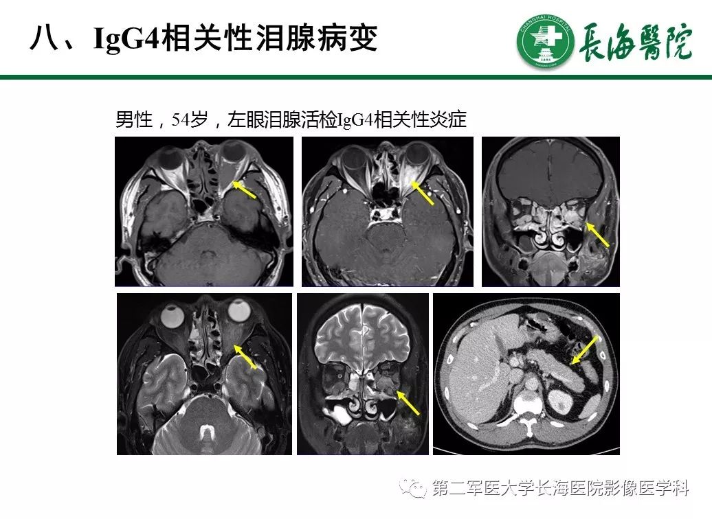 【PPT】IgG4相关性自身免疫性胰腺炎及相关性疾病