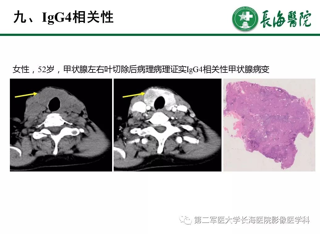 【PPT】IgG4相关性自身免疫性胰腺炎及相关性疾病