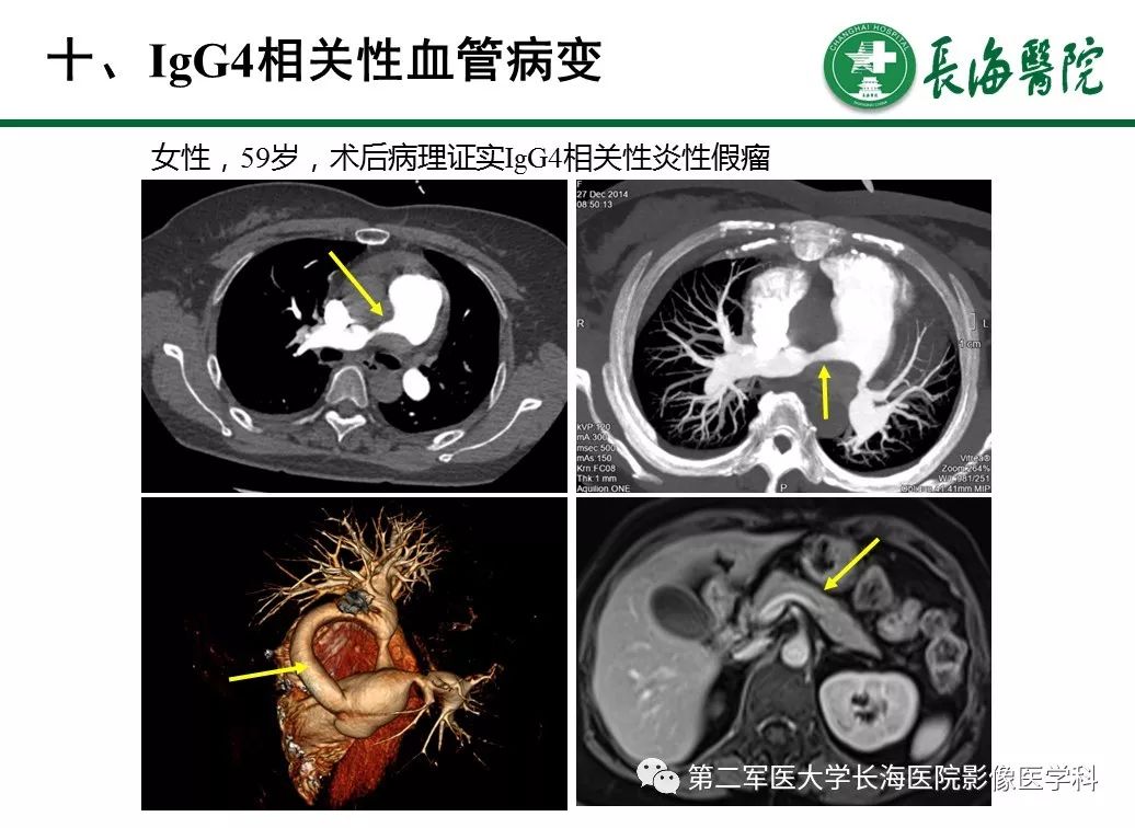 【PPT】IgG4相关性自身免疫性胰腺炎及相关性疾病