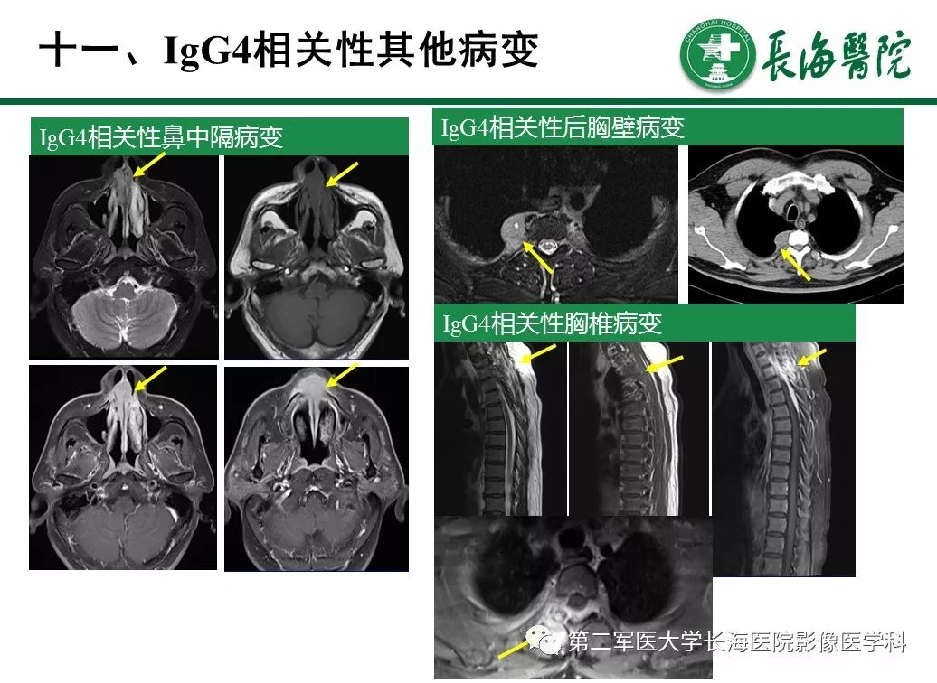 【PPT】IgG4相关性自身免疫性胰腺炎及相关性疾病