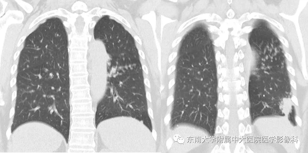 【PPT】结节病