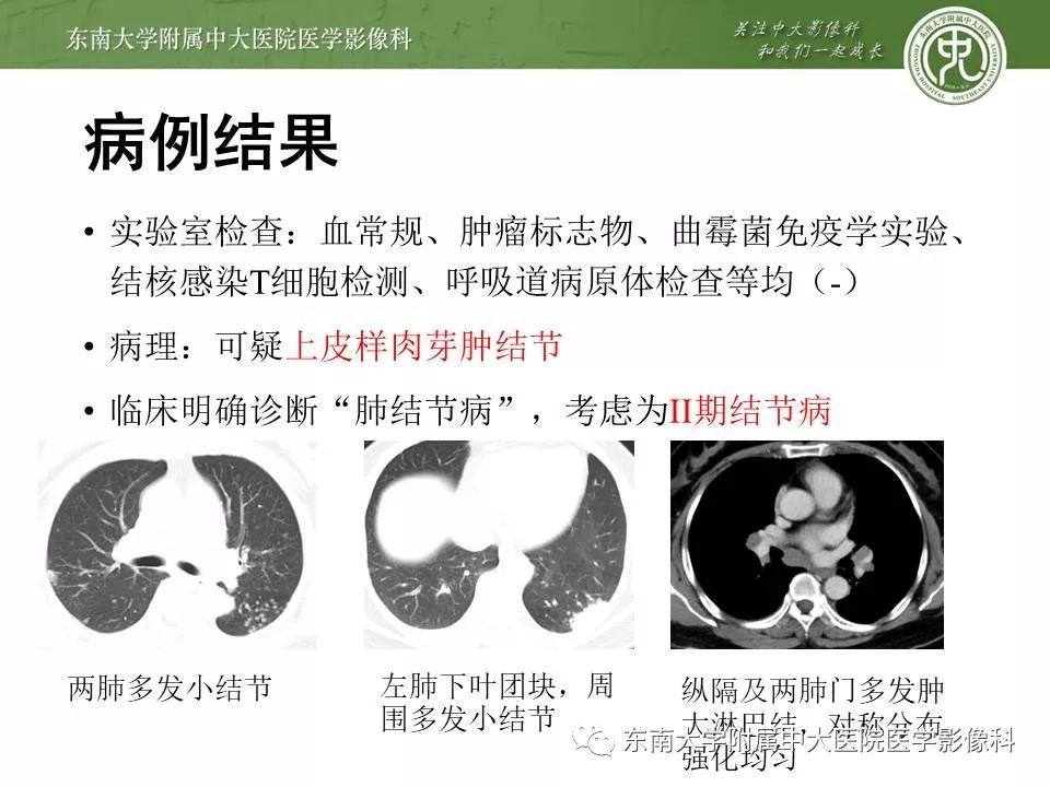 【PPT】结节病