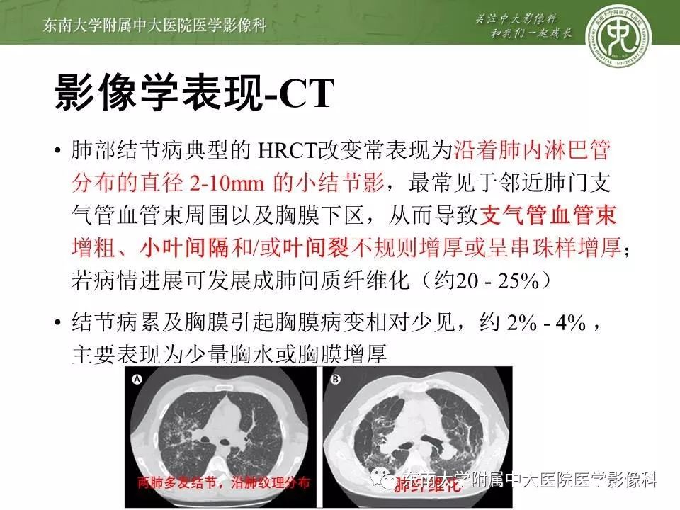 【PPT】结节病