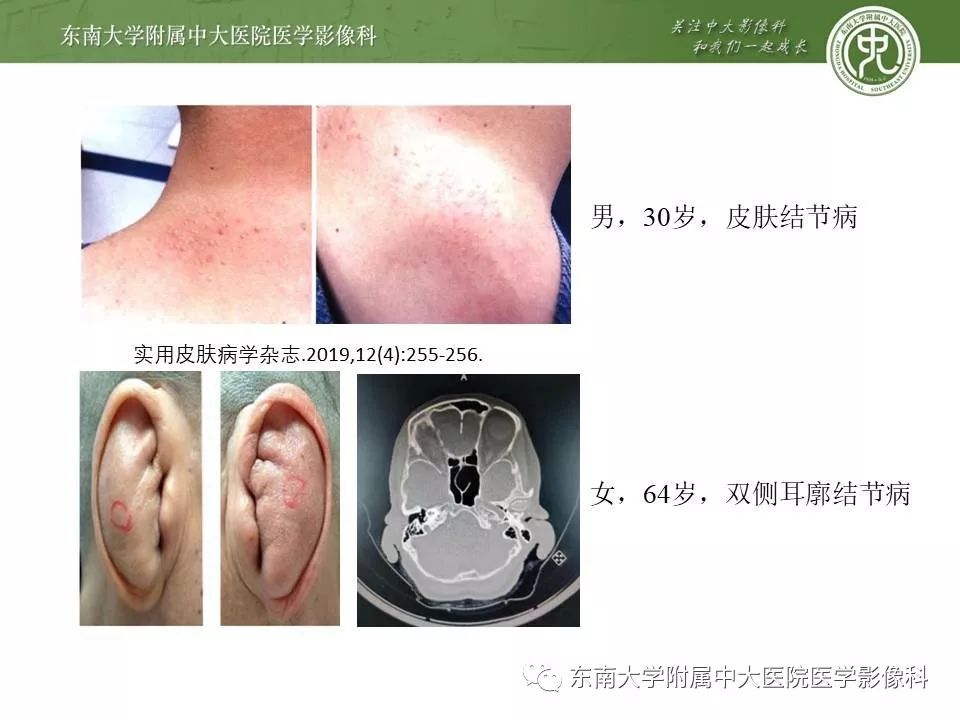 【PPT】结节病
