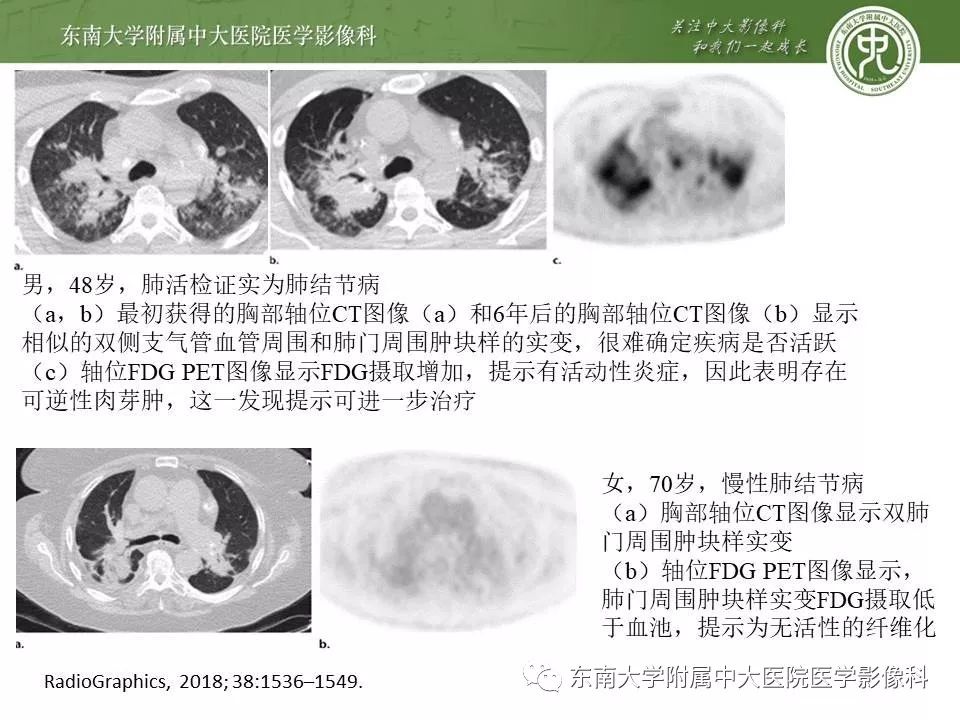 【PPT】结节病