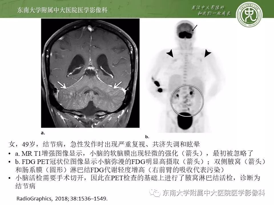 【PPT】结节病