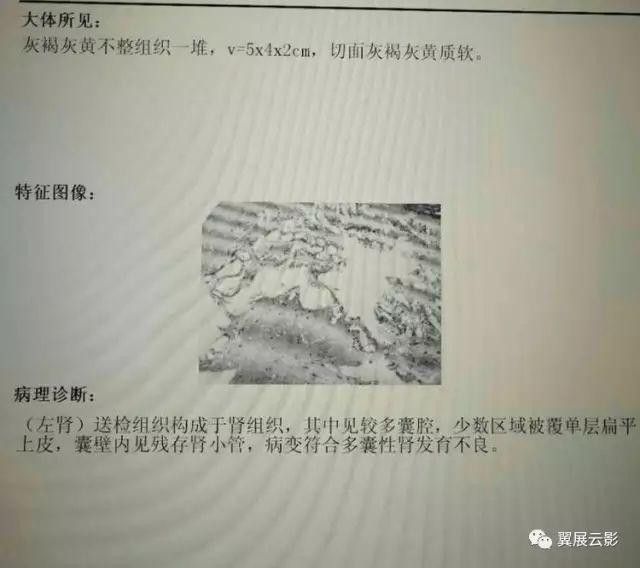 多囊性肾发育不良 多囊性肾发育不良
