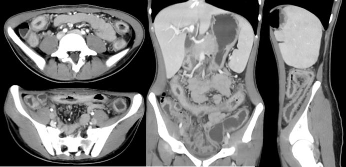 炎症性肠病的CT 特点 炎症性肠病的CT 特点