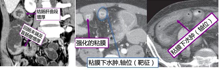 炎症性肠病的CT 特点 炎症性肠病的CT 特点