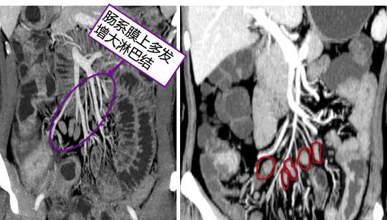 炎症性肠病的CT 特点 炎症性肠病的CT 特点