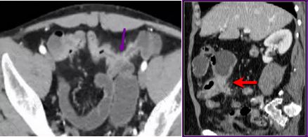 炎症性肠病的CT 特点 炎症性肠病的CT 特点