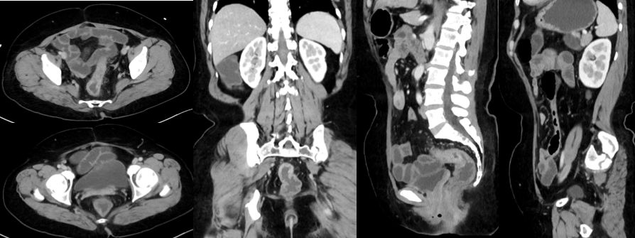 炎症性肠病的CT 特点 炎症性肠病的CT 特点