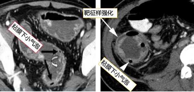炎症性肠病的CT 特点 炎症性肠病的CT 特点