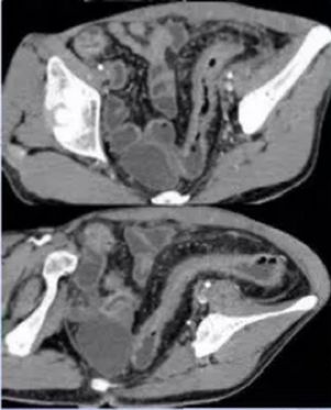 炎症性肠病的CT 特点 炎症性肠病的CT 特点