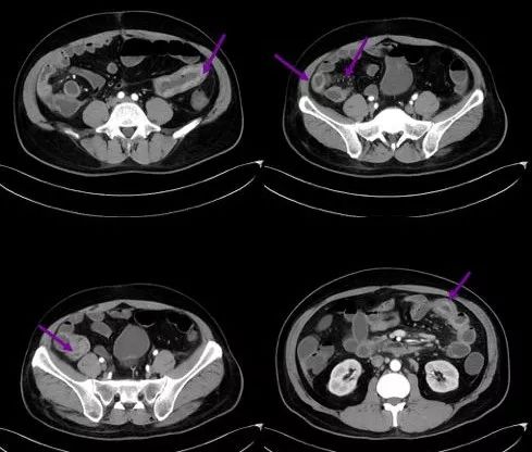 炎症性肠病的CT 特点 炎症性肠病的CT 特点