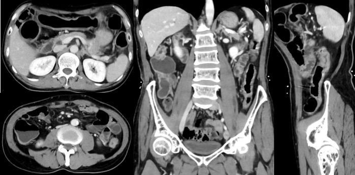 炎症性肠病的CT 特点 炎症性肠病的CT 特点