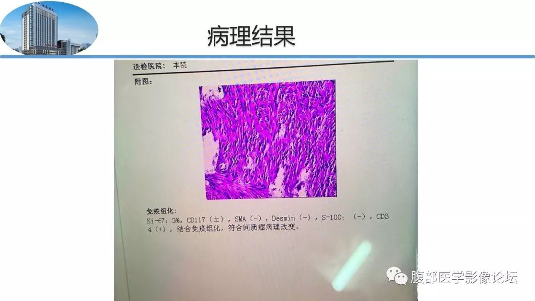 【病例】胃肠道间质瘤1例CT影像