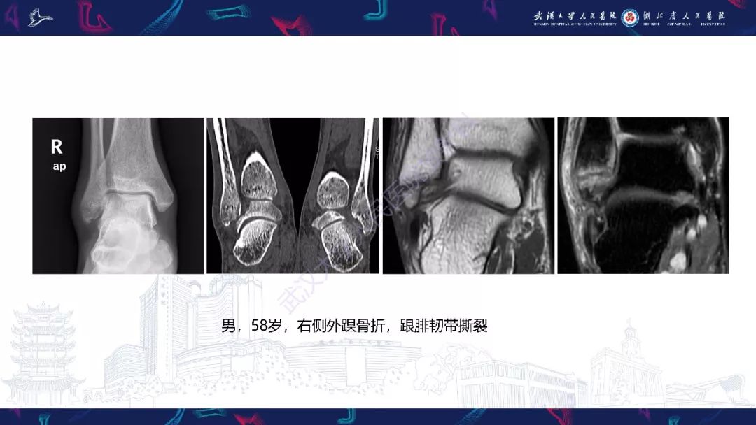 【PPT】踝关节运动损伤MR诊断