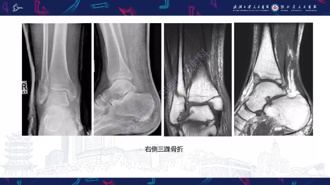 【PPT】踝关节运动损伤MR诊断