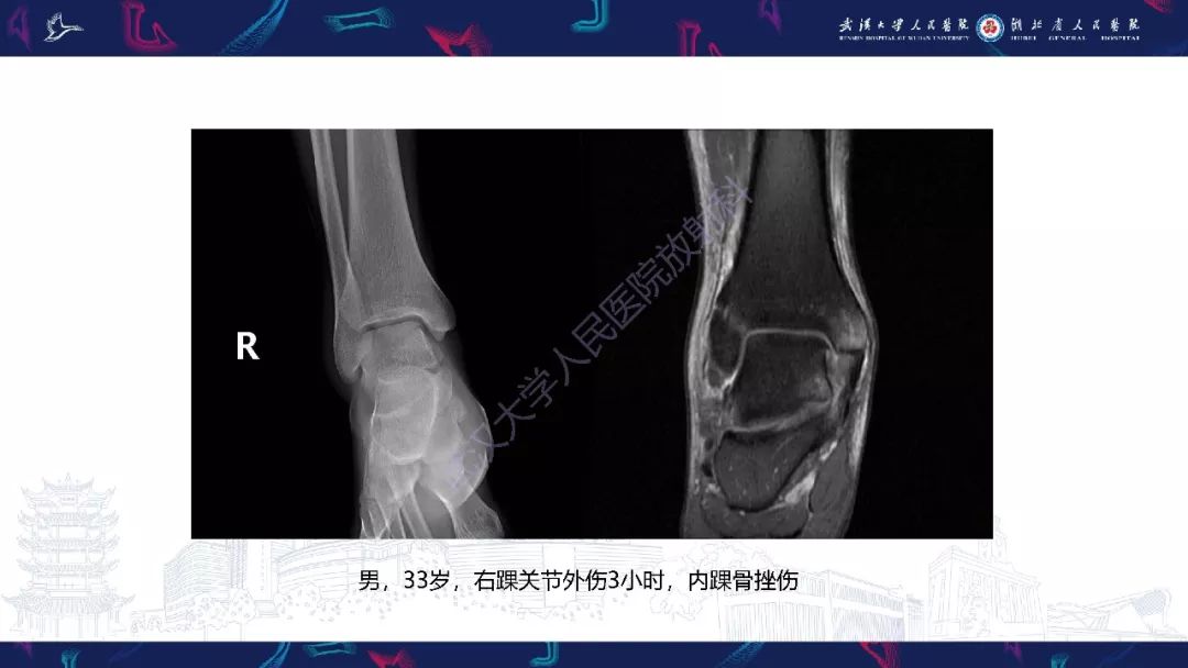 【PPT】踝关节运动损伤MR诊断