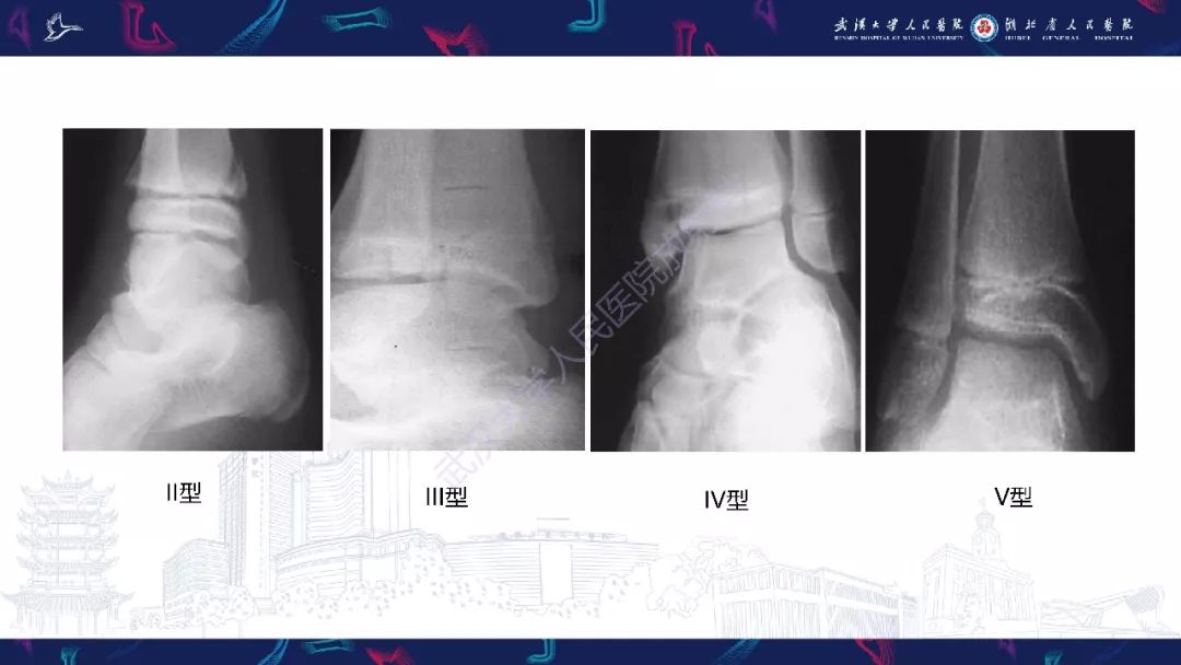 【PPT】踝关节运动损伤MR诊断