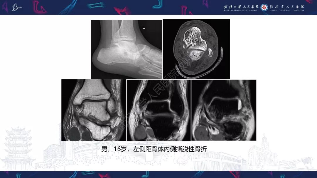 【PPT】踝关节运动损伤MR诊断