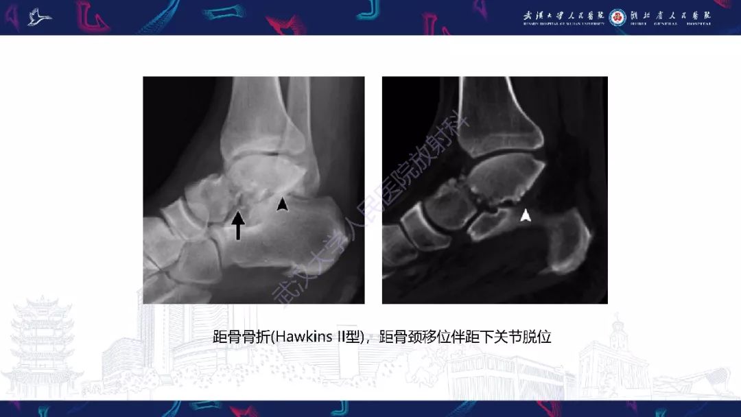 【PPT】踝关节运动损伤MR诊断