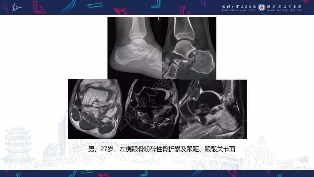 【PPT】踝关节运动损伤MR诊断