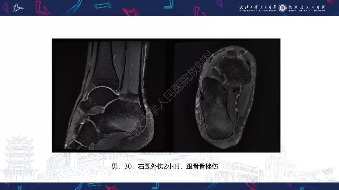 【PPT】踝关节运动损伤MR诊断
