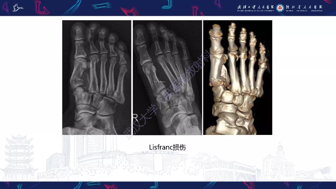【PPT】踝关节运动损伤MR诊断