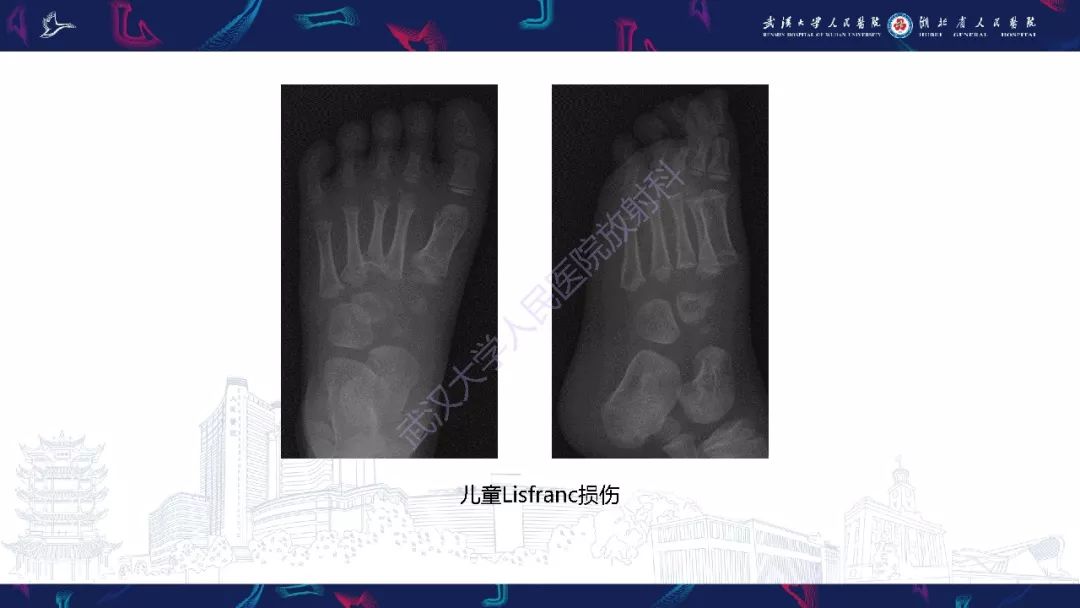 【PPT】踝关节运动损伤MR诊断
