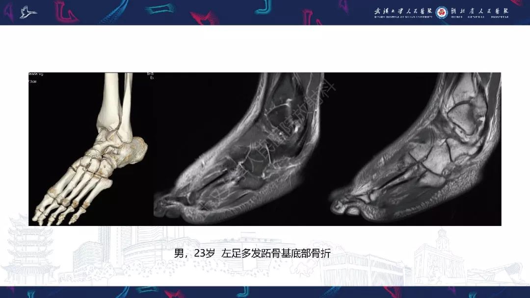 【PPT】踝关节运动损伤MR诊断