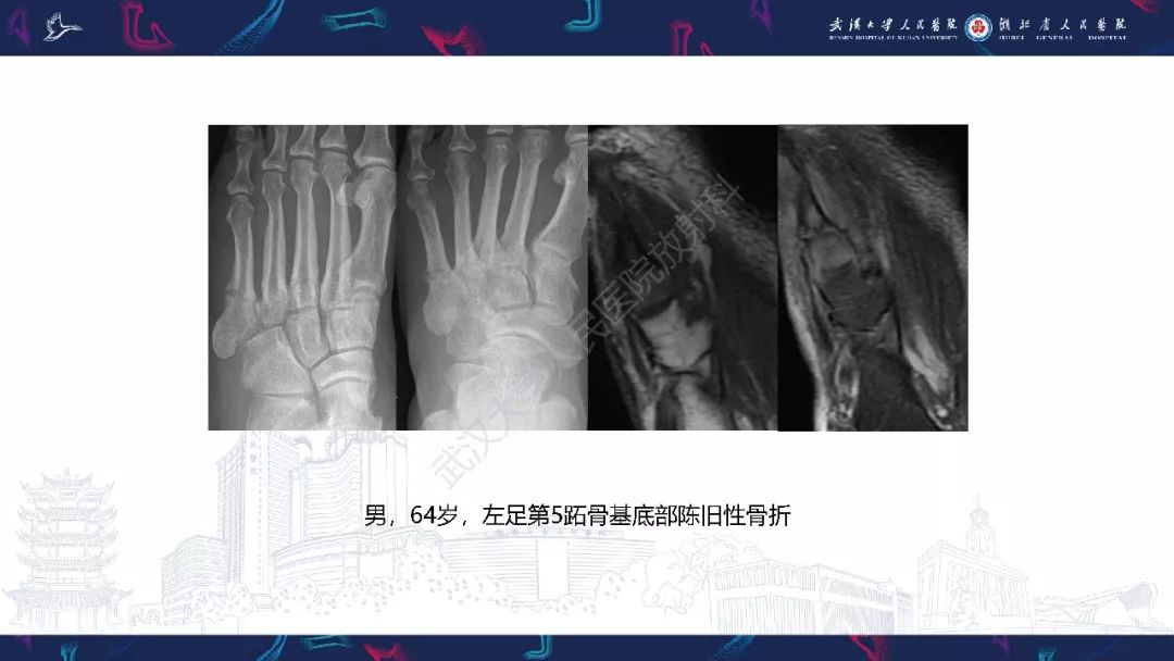 【PPT】踝关节运动损伤MR诊断